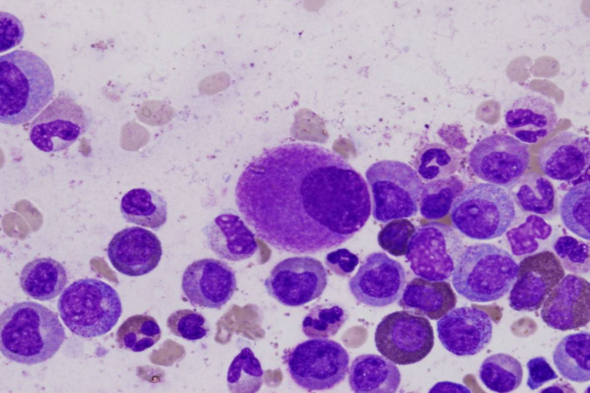 Leucemia mielomonocitica cronica