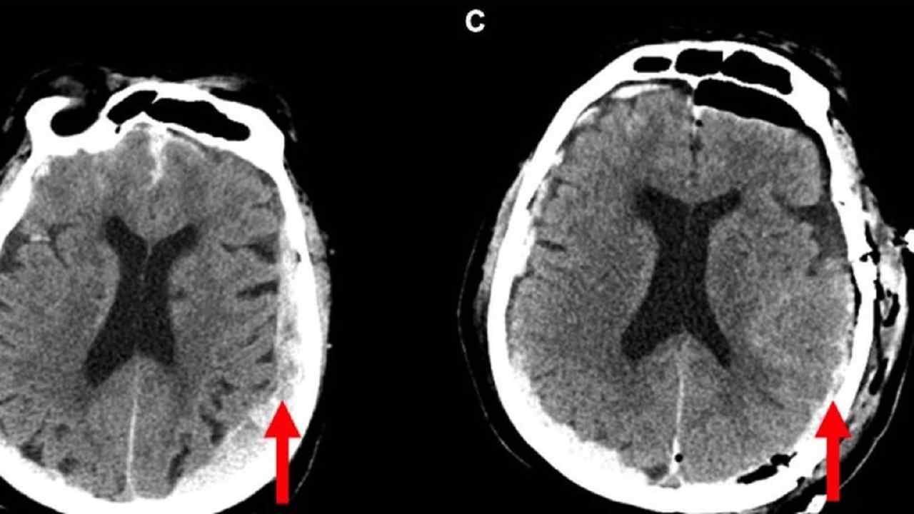 Una scansione di un cervello morente