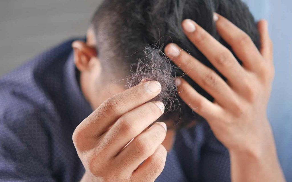 L'alopecia si manifesta con un'ingente perdita di capelli