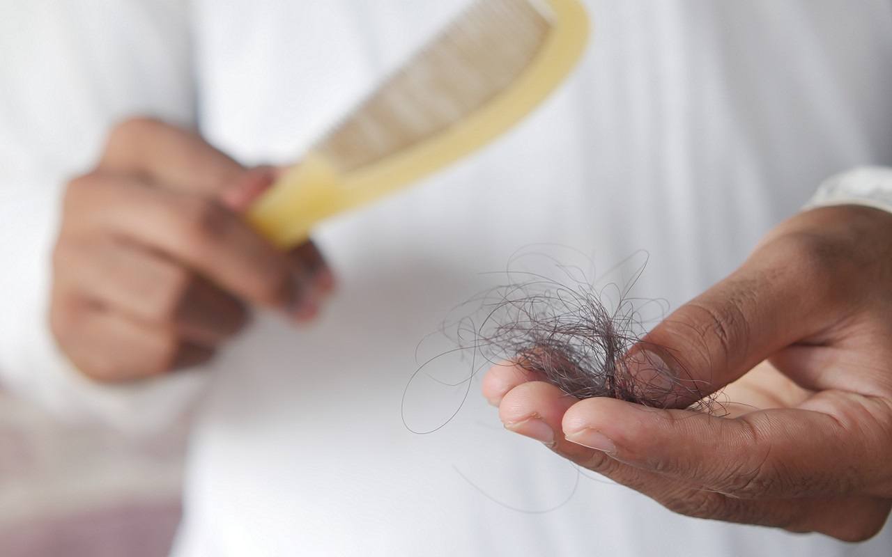 L'alopecia causa la perdita dei capelli