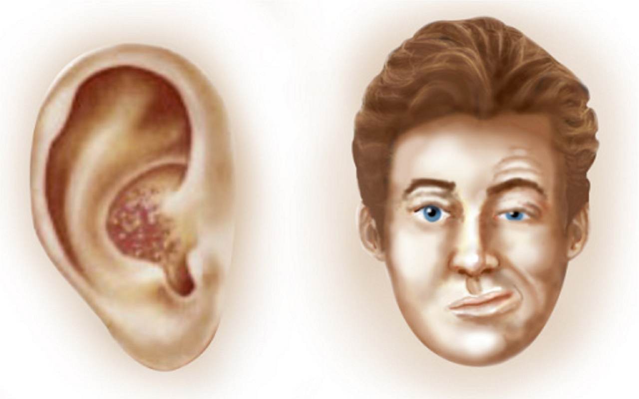 La sindrome di Ramsay Hunt