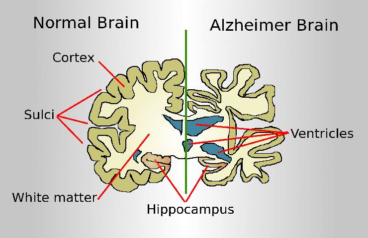 Gli effetti dell'Alzheimer sul cervello