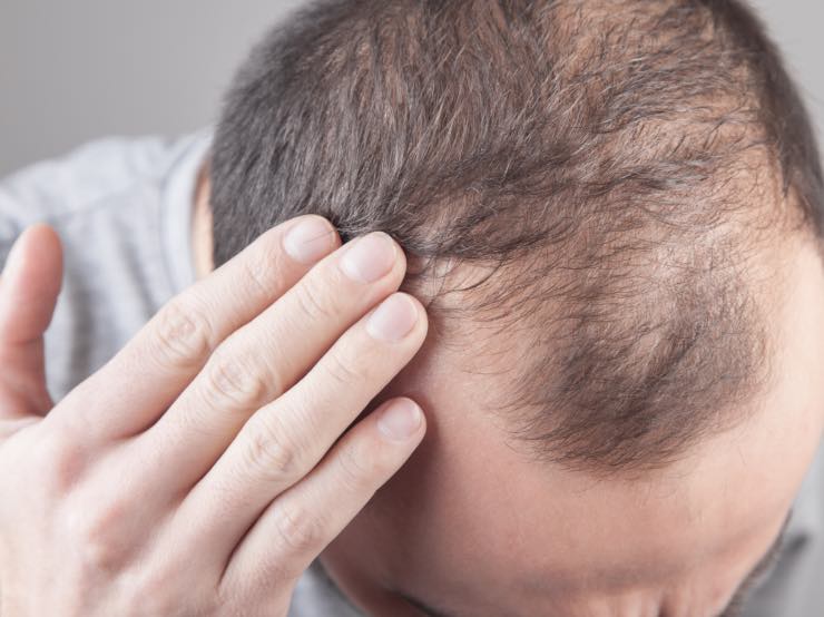 rimedi perdita capelli uomo