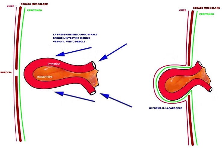 Rappresentazione di un laparocele addominale